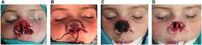 Case Report: Pediatric alloplastic nose reconstruction with a 3D printed patient specific titanium implant